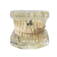 Dental Implant Teaching Model for Dentists & Students in Transparent, front view with jaws closed
